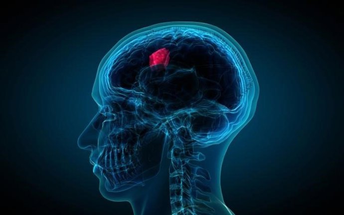 Archivo - Imagen de recurso de un glioblastoma.