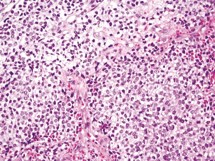 Sarcoma de Ewing.