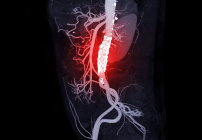 Archivo - Aneurismas de aorta torácica.