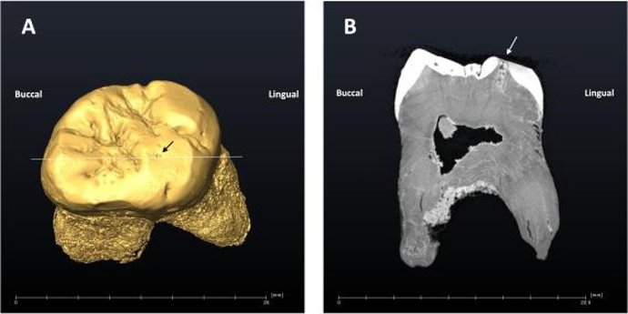 El séptimo caso conocido de una caries dental en un neandertal
