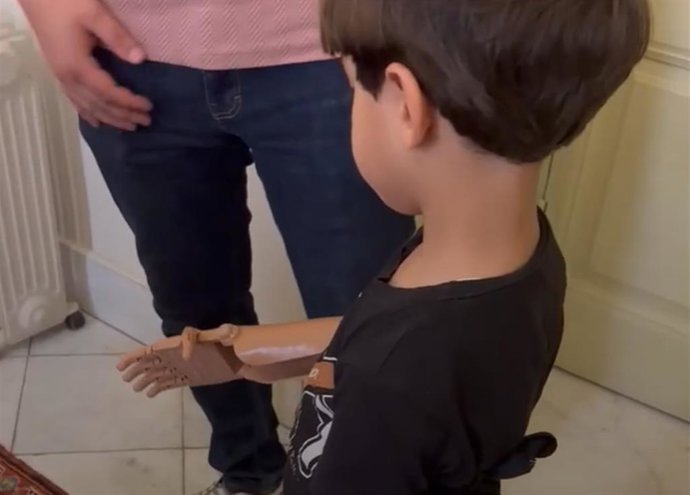 Omar prueba su prótesis impresa en 3D