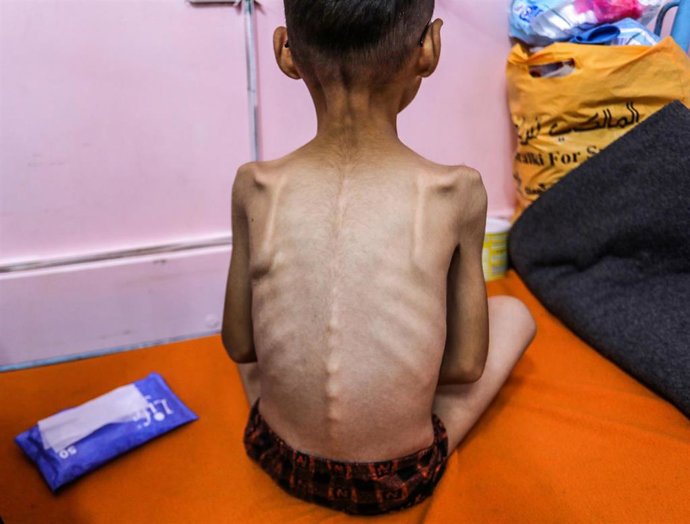Archivo - Niño palestino con desnutrición aguda recibe atención en el Hospital Naser de Jan Yunis, en el sur de la Franja de Gaza, en medio de la ofensiva de Israel y sus restricciones a la entrega de ayuda humanitaria (archivo)