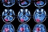 Foto: Cáncer cerebral: un nuevo modelo de análisis para predecir su propagación y progresión