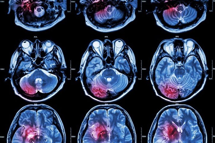 Archivo - Tumor cerebral.