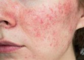 Foto: La SEAIC destaca que los últimos avances terapéuticos abren la puerta a controlar la dermatitis atópica grave