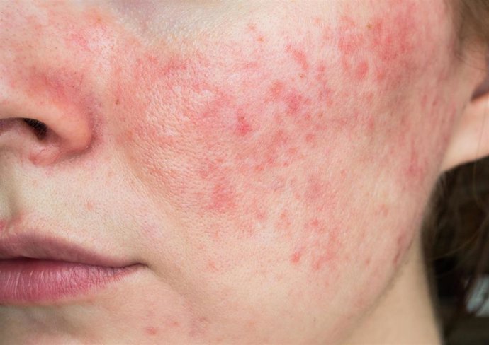 Archivo - Imagen de recurso de una persona con dermatitis atópica.