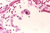 Foto: Encuentran una forma de usar anticuerpos para dirigir a las células T a matar las células infectadas por citomegalovirus
