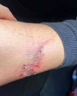 Mordedura de perro recibida por un agente de la Policía Nacional durante una operación antidroga en Melilla