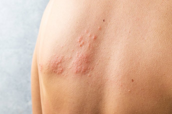 Archivo - Arquivos - Herpes Zoster