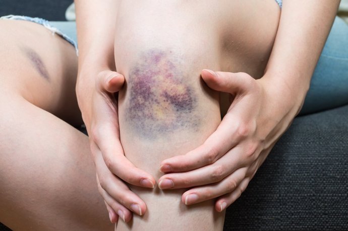 Archivo - Hematoma.