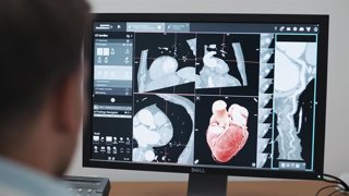 Los avances en el diagnóstico y tratamiento del ataque cardíaco logran disminuir su tasa de mortalidad