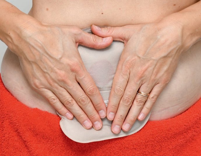 Archivo - Arquivo - A enfermeira de estomaterapia María del Carmen Alcántara, do Hospital Virgen de la Victoria, em Málaga, e membro do Proyecto Gesto, faz parte do 'Sintonía paciente', o primeiro podcast sobre ostomia e incontinência criado pela Holliste