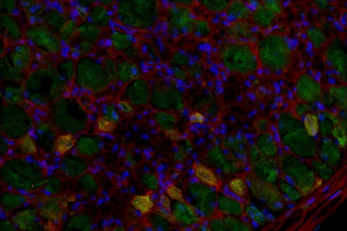 Inhibir la enzima glutaminasa podría reducir el dolor neuropático crónico que padecen millones de personas sin tratamiento eficaz, según un estudio de UNIR.