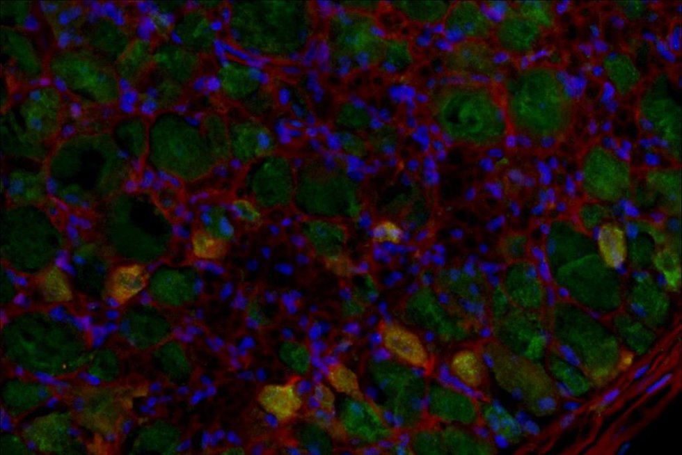 Inhibir la enzima glutaminasa podría reducir el dolor neuropático crónico que padecen millones de personas sin tratamiento eficaz, según un estudio de UNIR.
