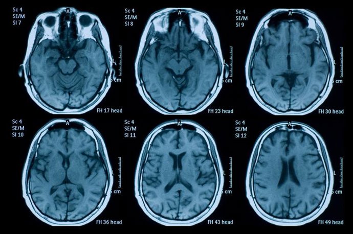 Descubren Un Compuesto Que Podría Cambiar El Tratamiento De Las Lesiones Cerebrales Traumáticas