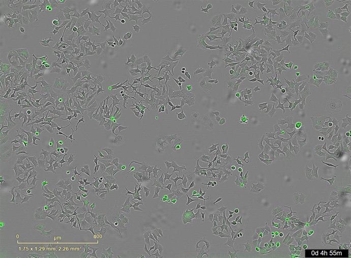 La imagen representa las células de cáncer muertas al activarse su proteína de membrana PAR-1 por la proteasa bacteriana HapA.