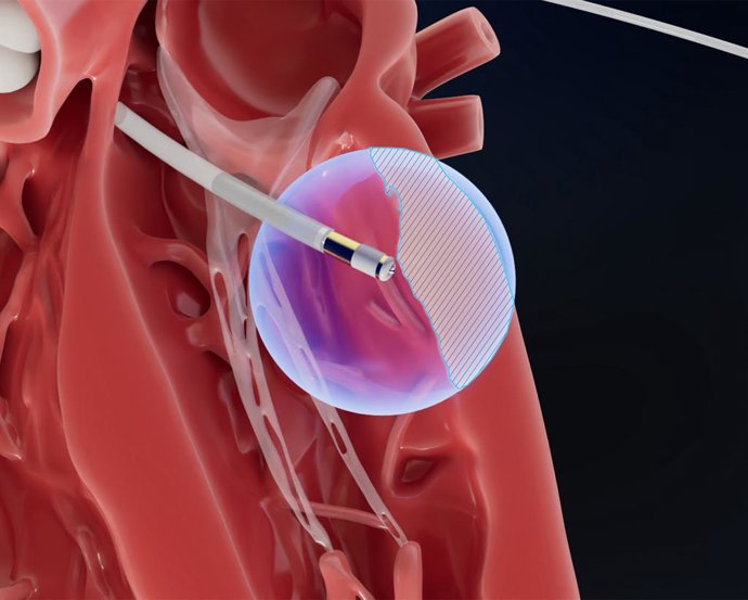 Field Medical: Engineered to reach the epicardium from the endocardium, the FieldForce Ablation System catheter is designed to enable focal pulsed field ablation for full-thickness, transmural lesions.