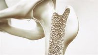 Médicos internistas llaman a diagnosticar la osteoporosis también en mujeres premenopáusicas y en varones