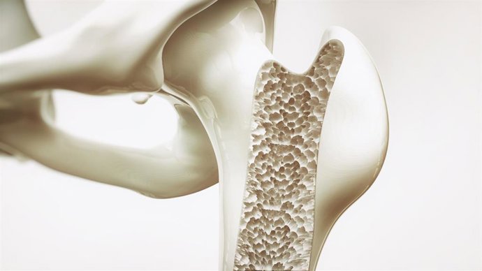 Archivo - Imagen de recurso de un hueso con osteoporosis