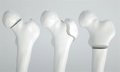 La tomografía computarizada oportunista se posiciona como herramienta prometedora para el diagnóstico de la osteoporosis