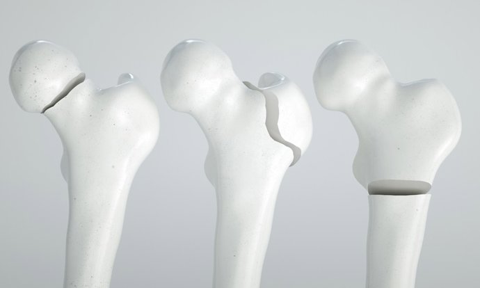 Archivo - Fracture of the femur - breakpoints 1  4 - 3D