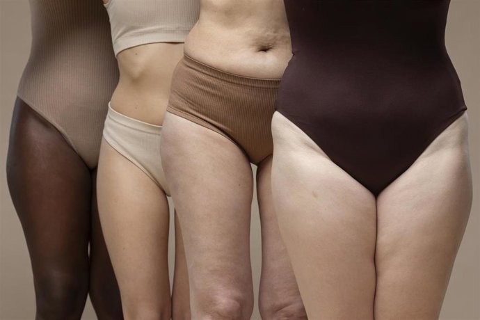 Archivo - Mujeres con lipedema.