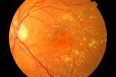 Foto: Un implante de retina restaura la visión central en pacientes con DMAE avanzada
