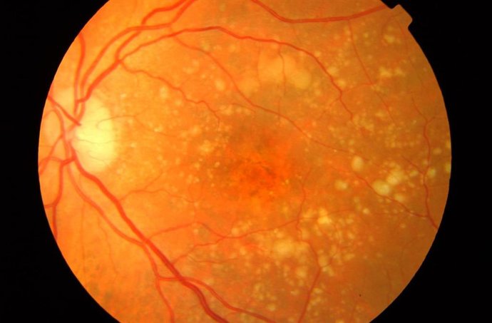 Archivo - Imagen de recurso de una retina con DMAE.