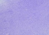 Foto: Pazopanib muestra prometedora tasa de supervivencia del 85% a dos años en niños con sarcoma de Ewing multimetastásico