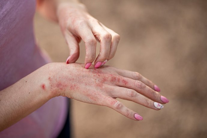 Archivo - Arquivo - Eczema dermatite