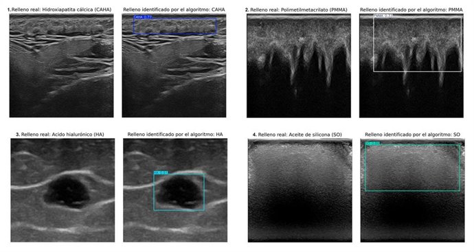 Ecografías que muestran rellenos estéticos identificados por un especialista (izquierda) y las regiones detectadas por el algoritmo (derecha). En los cuatro casos, el algoritmo acertó en clasificar y delimitar el área de cada relleno.