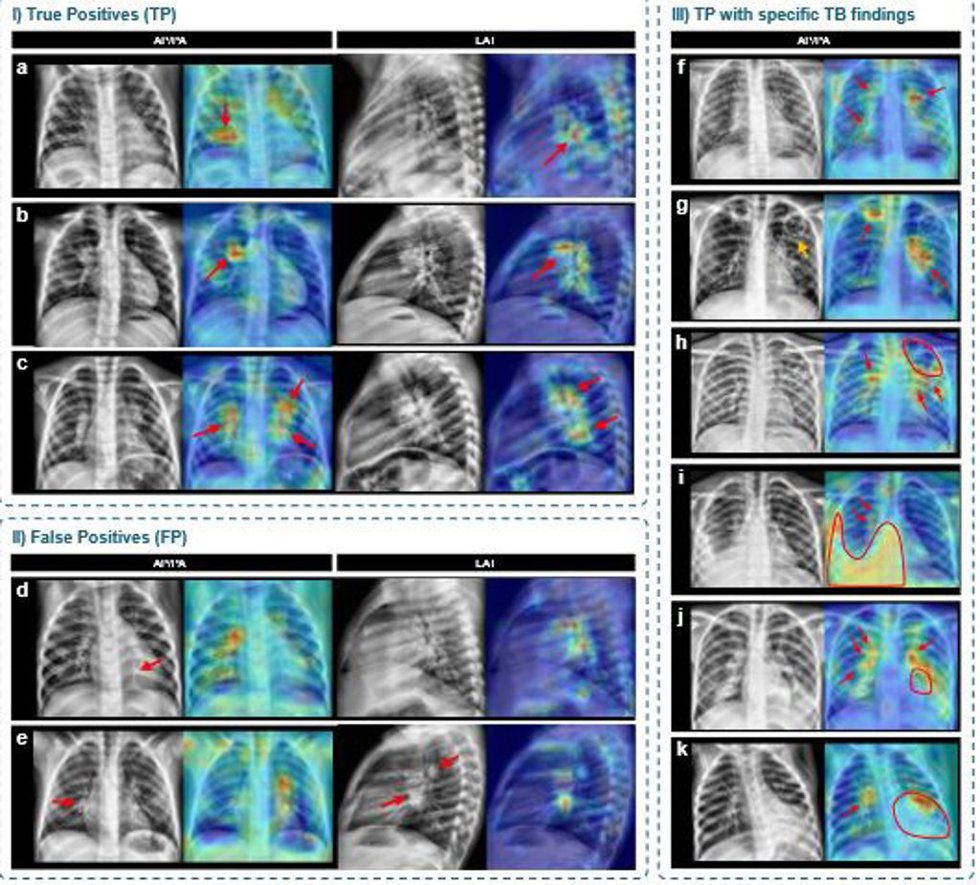 Mapas de activación generados mediante técnicas de explicabilidad que señalan las regiones de interés utilizadas por el modelo para tomar sus decisiones sobre las radiografías