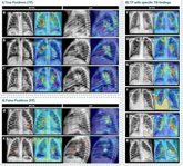 Foto: Un sistema basado en Inteligencia Artificial permite detectar radiografías compatibles con tuberculosis en niños