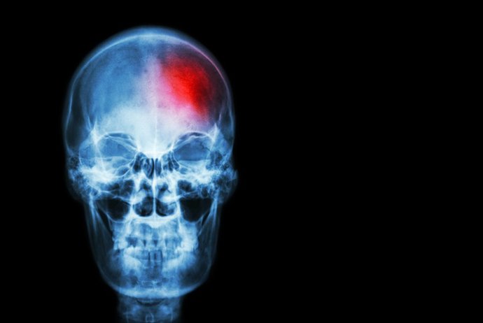 Archivo - Arquivo - Acidente vascular cerebral