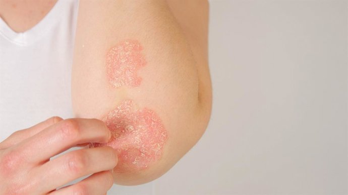 Archivo - CLOSE UP: Unrecognizable young woman suffering from autoimmune incurable dermatological skin disease called psoriasis. Female gently scratching red, inflamed, scaly rash on elbows. Psoriatic arthritis
