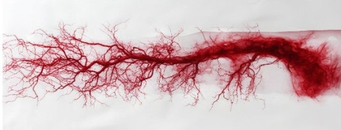 La arteritis de células gigantes afecta principalmente a arterias de gran y mediano calibre, como las que Irrigan la cabeza y el cuello.