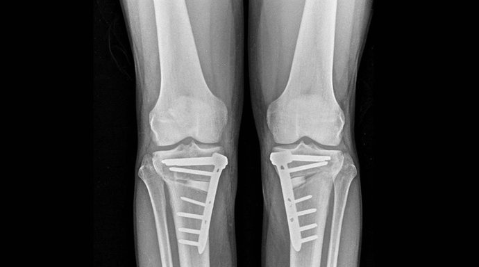 Radiografías de rodilla.