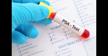 Un estudio plantea tratar el cáncer de próstata durante seis meses, en lugar de dos años, tras la cirugía