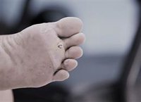 Podólogos advierten de que mortalidad en pacientes con diabetes que sufren una amputación supera el 56% a los cinco años