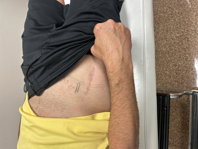 Cicatriu operació maluc