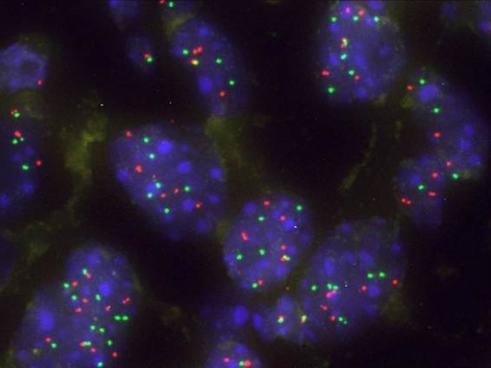 Archivo - Una proteína actúa como barrera natural frente a la progresión del cáncer de pulmón