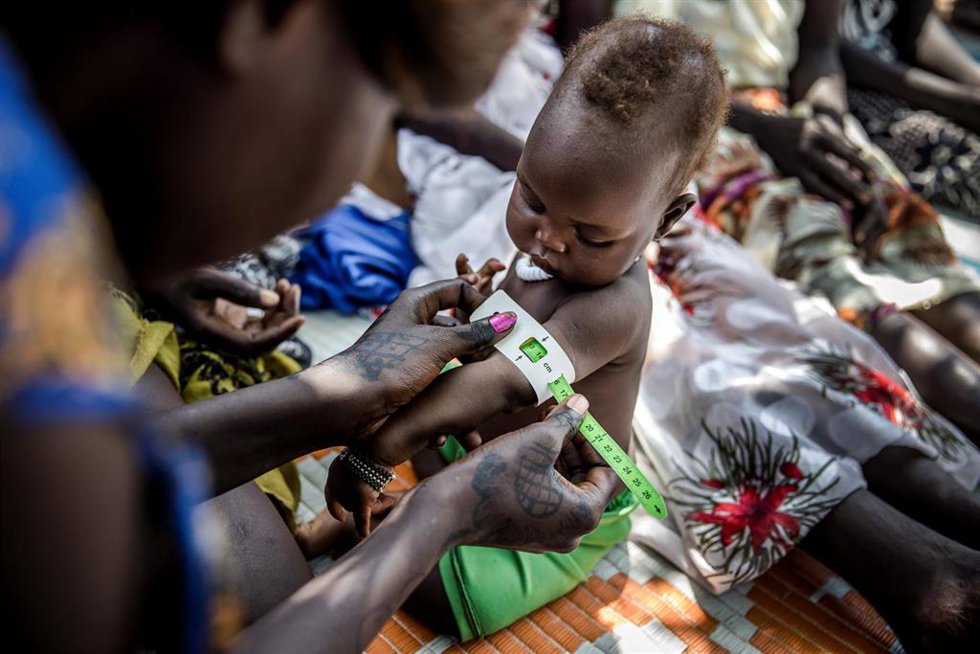 Medición del nivel de malnutrición de un niño en un campo de refugiados de Etiopía.