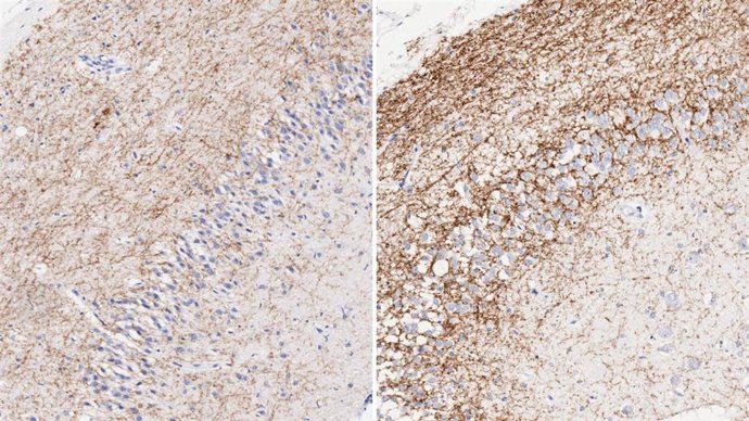 Detalle del hipocampo en personas sin y con síndrome de Down.