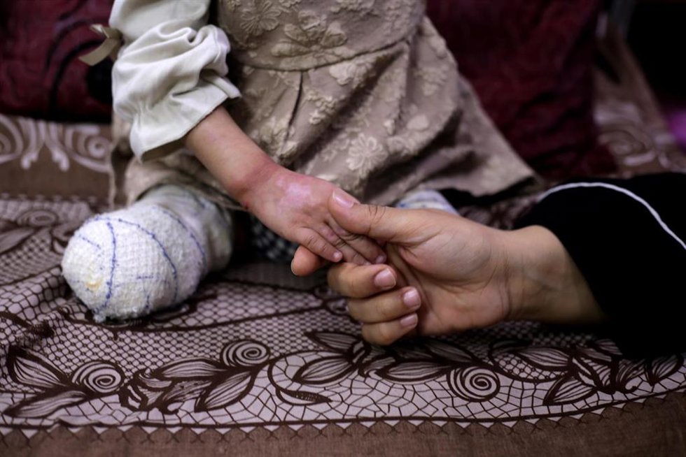 Archivo - Un niño amputado en el Hospital Mártires de Al Aqsa, en la ciudad de Deir al Balá, a causa de la ofensiva lanzada por Israel contra la Franja de Gaza tras los ataques del 7 de octubre de 2023 (archivo)
