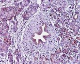 Foto: La Sociedad de Patología Digestiva recuerda que el cáncer de páncreas tiene una elevada mortalidad