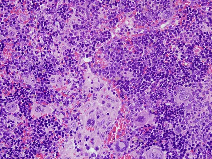 Archivo - Imagen de microscopia de un linfoma desarrollado por ratones con alteraciones en el gen VAV1.