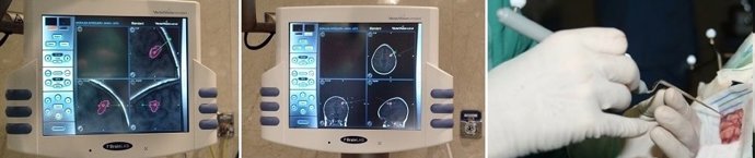 La neuronavegación permite tratar "con mayor precisión" los tumores cerebrales y la estenosis lumbar
