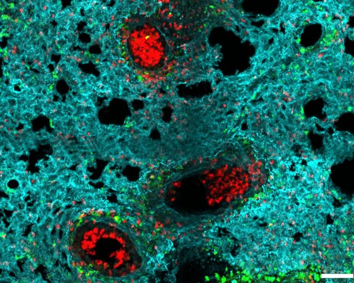 Neutrófilos (rojo) se acumulan en los alveolos de un pulmón infectado con gripe.