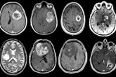 Foto: Descubren cómo anillos de ADN podrían revelar el glioblastoma antes de que aparezca el tumor