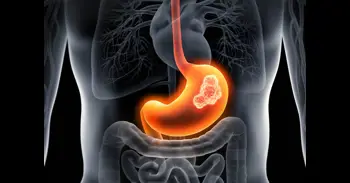 Un nuevo estudio muestra que la bacteria 'Streptococcus anginosus' puede promover el cáncer de estómago